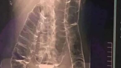 The X Ray That Exposed a Young Woman s Chronic Constipation