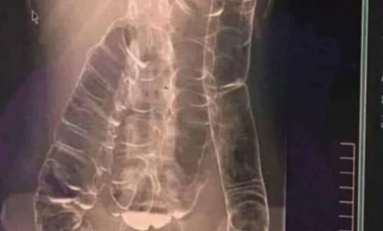 The X Ray That Exposed a Young Woman s Chronic Constipation